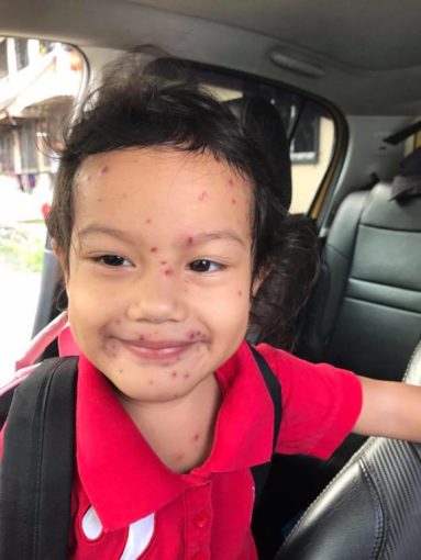 tanda chicken pox