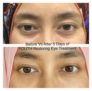 cara hilangkan eyebag