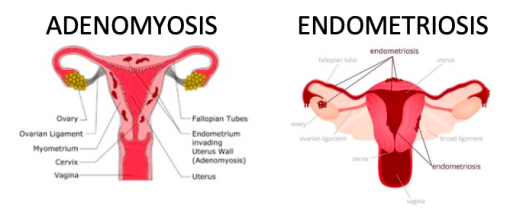endometriosis-cegah endometriosis-cara merawat endometriosis-edometriosis dapat anak-cara mengandung-mengandung dan endometriosis-vivix shaklee-endometriosis vivix-kebaikan vivix-vivix murah-kelebihan vivix-shaklee ninasalleh