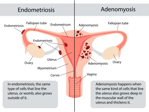 punca penyakit endometriosis beza endometriosis adenomyosis