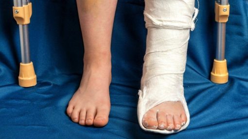 cepatkan sembuh patah tulang