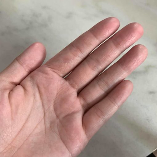 hilangkan eczema tanpa steroid