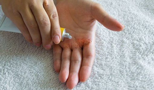 hilang eczema tanpa steroid