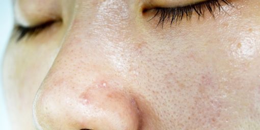jenis kulit muka berminyak jenis kulit muka