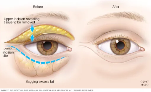 cara hilangkan eyebag