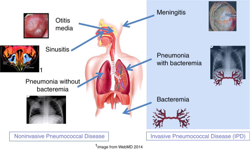 vaksin bayi vaksin pneumococcal