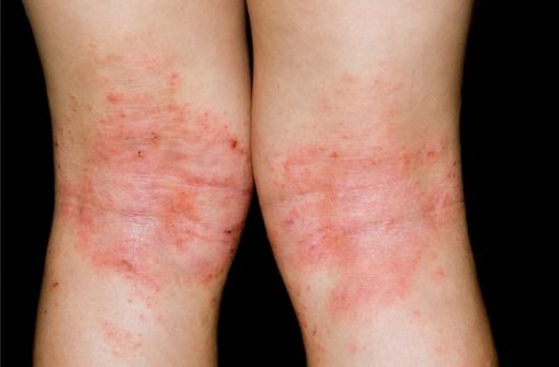 cara hilangkan eczema eczema kaki kering