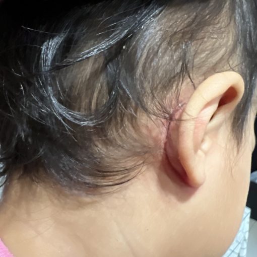 hilangkan eczema anak eczema belakang telinga