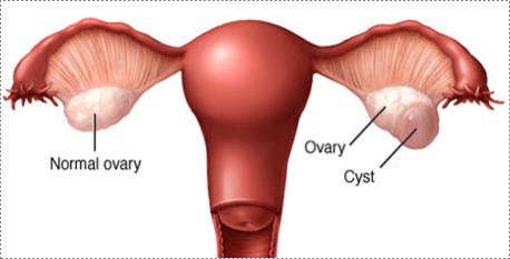 ovarian cyst