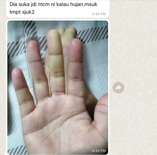 gejala penyakit sle