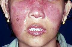 butterfly rashes sle