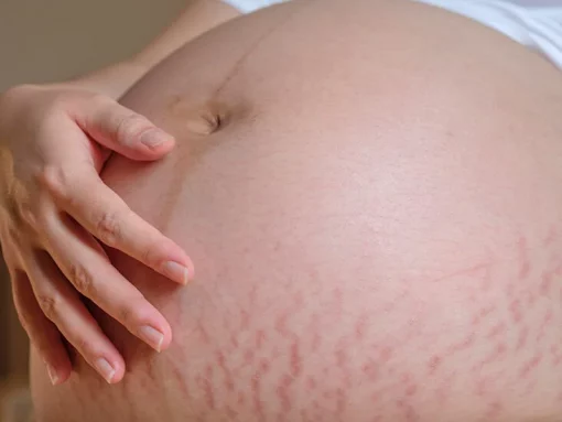 masalah ibu mengandung cara elakkan stretch mark