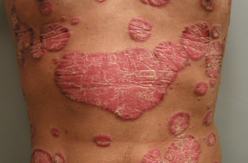 cara hilangkan psoriasis