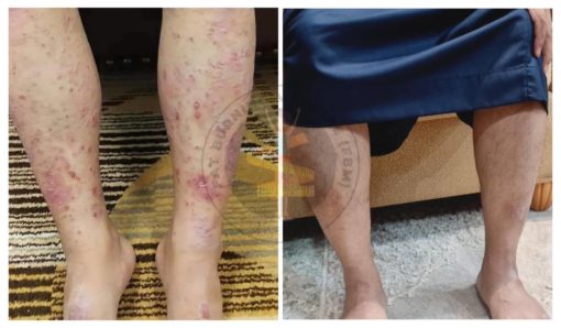 psoriasis cara hilangkan