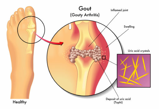 cara diet pesakit gout