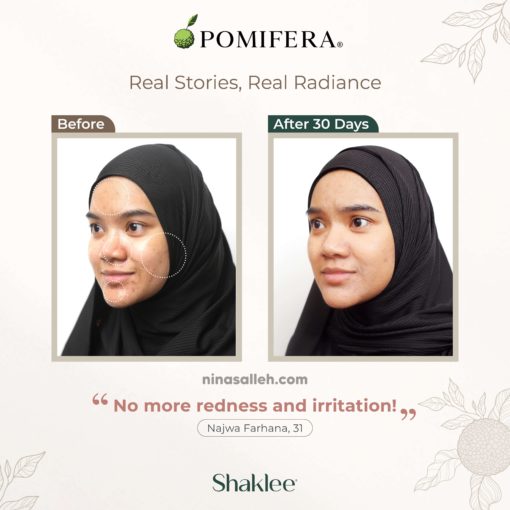 cara hilangkan jerawat skincare hilangkan jerawat