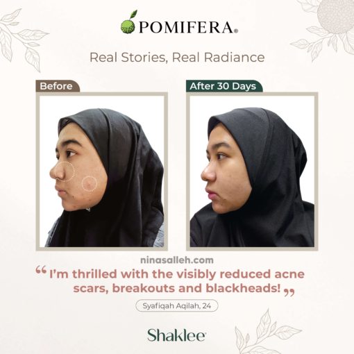 skincare berkesan hilangkan jerawat skincare hilangkan parut jerawat
