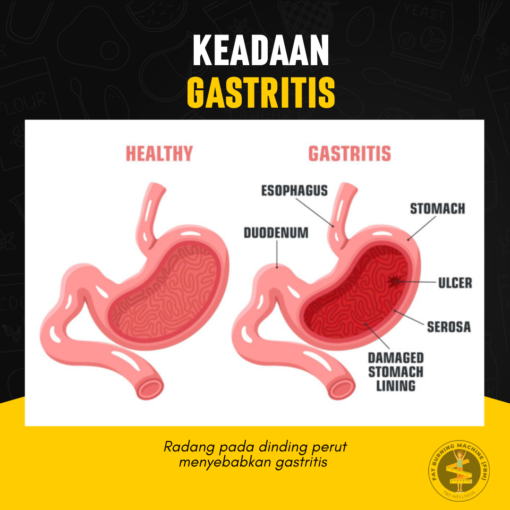 gerd gastrik anxiety
