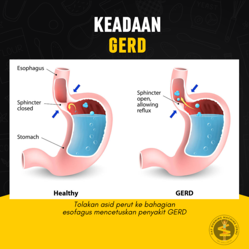 gerd gastrik anxiety