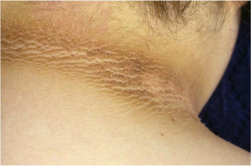 tanda insulin resistance cara hilangkan hitam celah leher