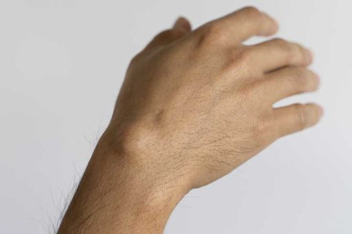 cara kecutkan cyst tanpa pembedahan cara kecutkan cyst