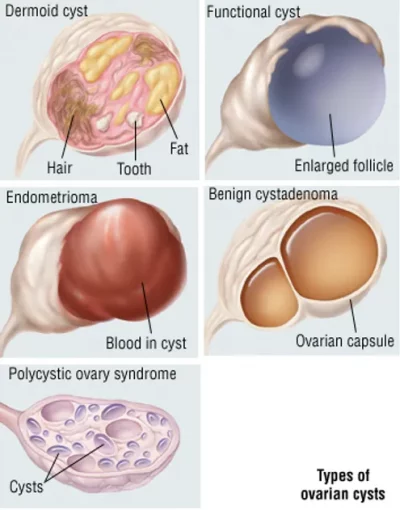 ovarian cyst kecutkan cyst tanpa bedah