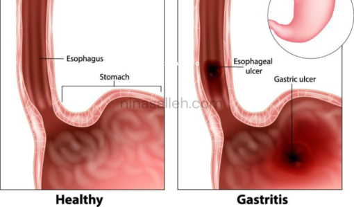 makanan punca gastrik cara hilangkan gastrik