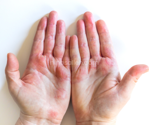 cara kurangkan eczema cara sembuhkan eczema