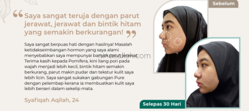 cara hilangkan parut jerawat hitam