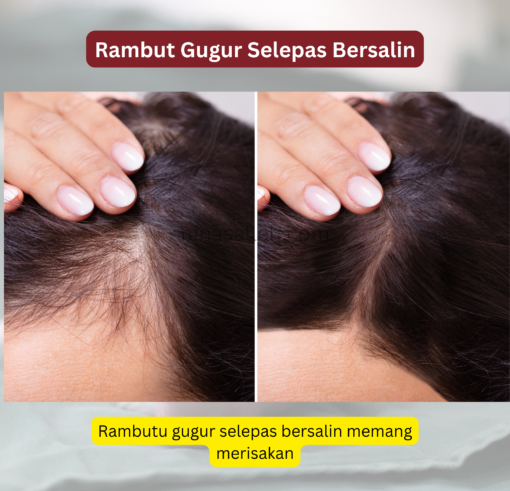 rambut gugur selepas bersalin vitamin rambut gugur lepas bersalin